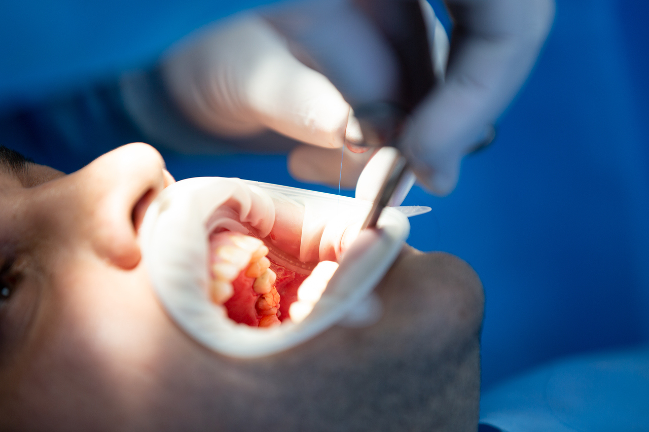 Стоматолог назвал причины появления зубного камня
